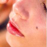Dangerous moles and patches 